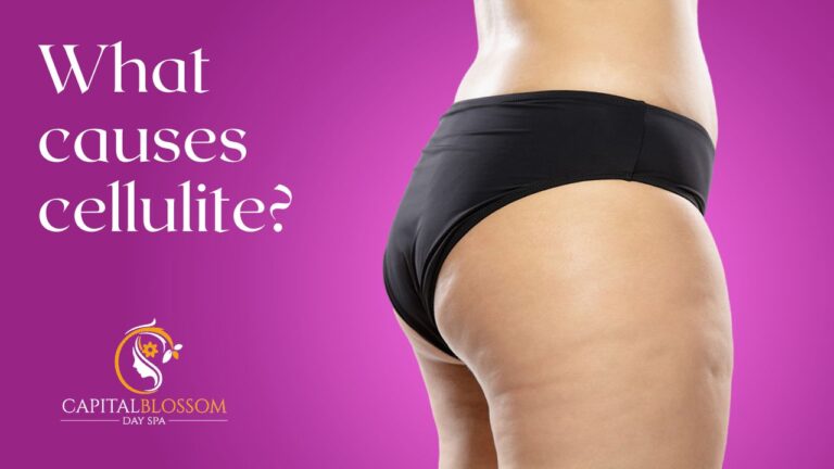 What Causes Cellulite Exploring The Underlying Factors