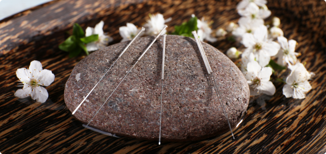 Read more about the article What Does Acupuncture Do and Does It Work?