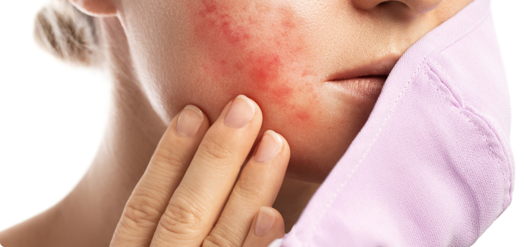 Read more about the article Top 5 Tips To Avoid Maskne Breakouts