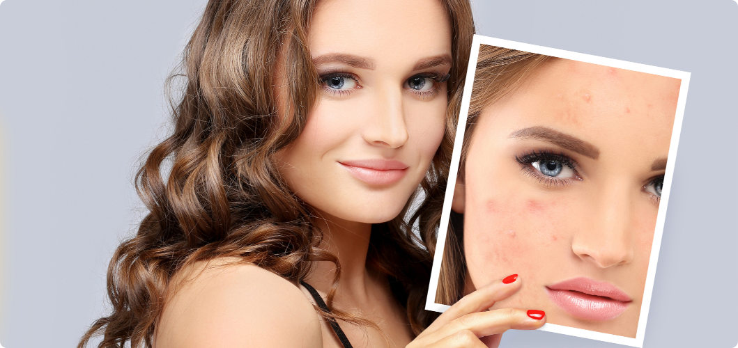 Read more about the article Say Goodbye to Acne: Tips for Treating and Preventing Breakouts