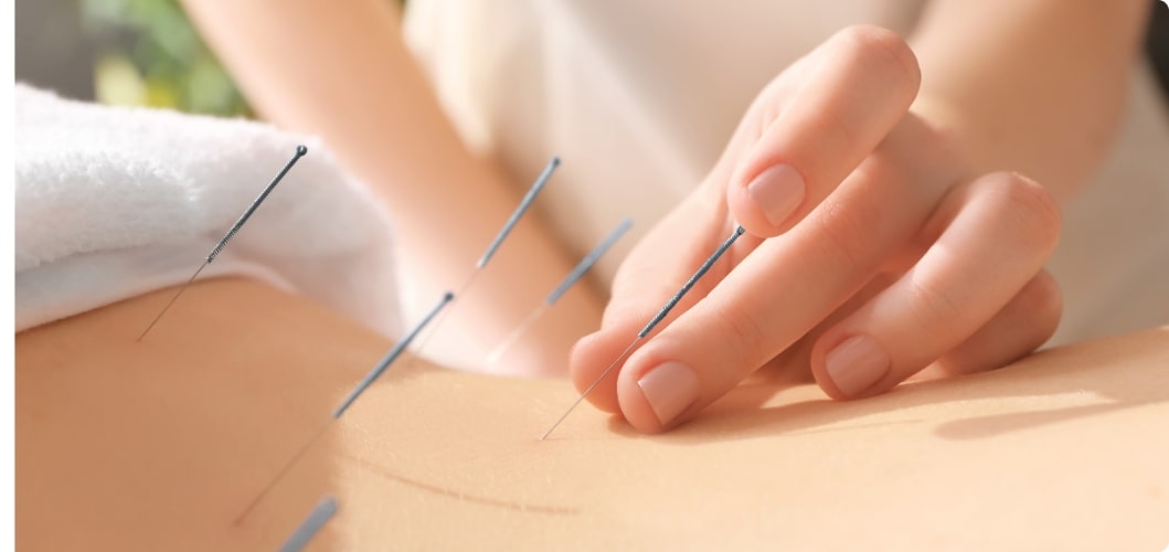 Read more about the article Acupuncture for Weight Loss: Unveiling the Ancient Healing Art and Its Potential Benefits