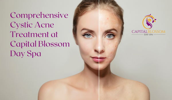 Read more about the article Comprehensive Cystic Acne Treatment at Capital Blossom Day Spa