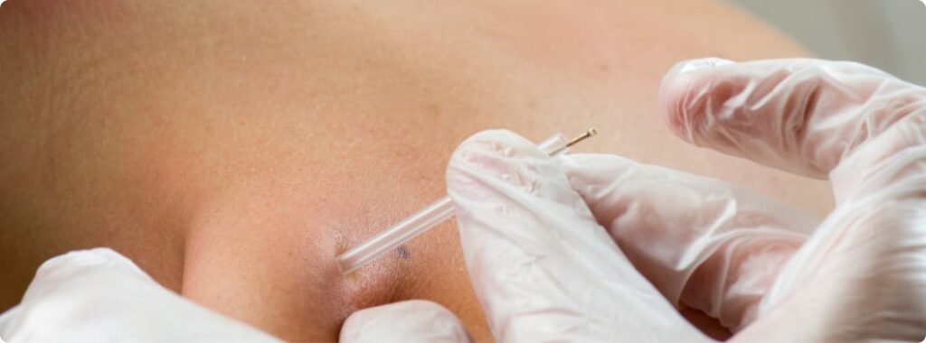 dry needling vs acupuncture