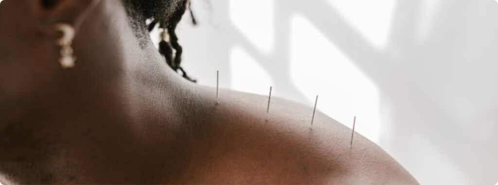 dry needling vs acupuncture