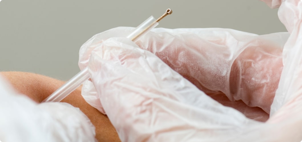 Read more about the article Dry Needling vs. Acupuncture: Unraveling the Differences in Traditional Healing Techniques