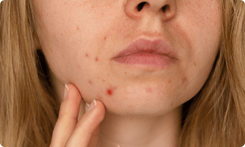 fungal acne treatment