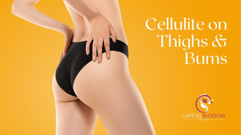 6 Ways to Treat—and Get Rid of—Cellulite - Washingtonian