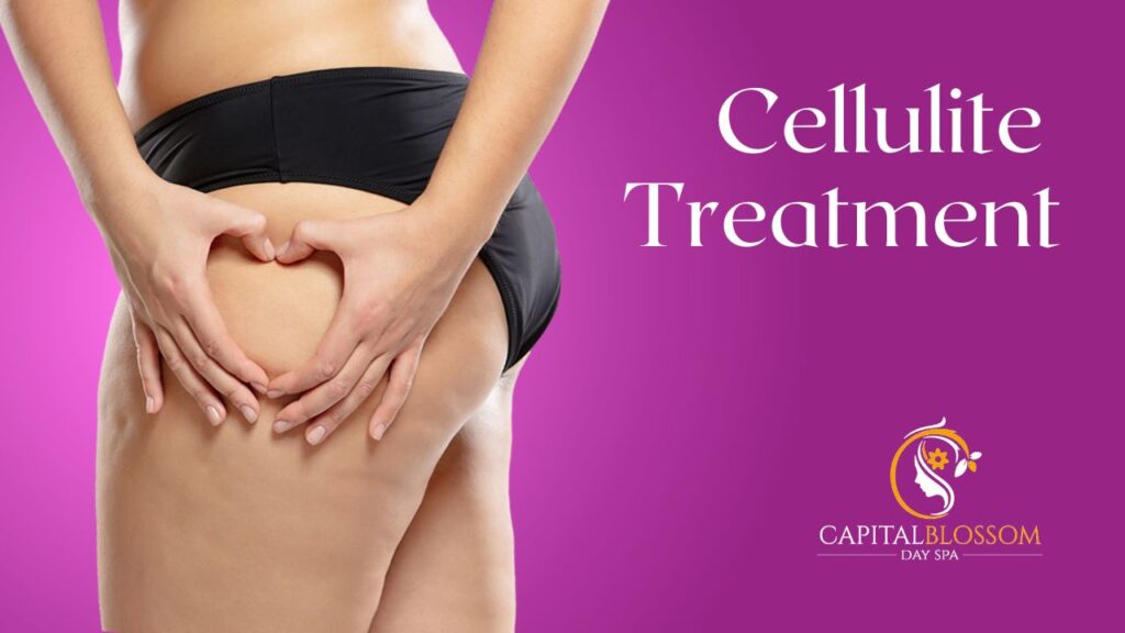 cellulite treatment