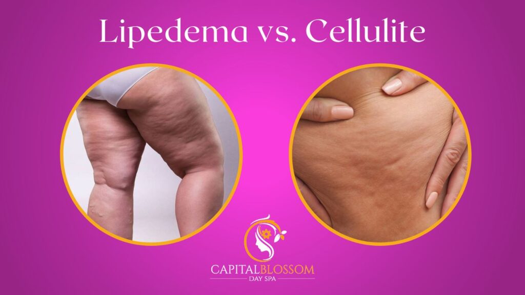 lipedema vs cellulite