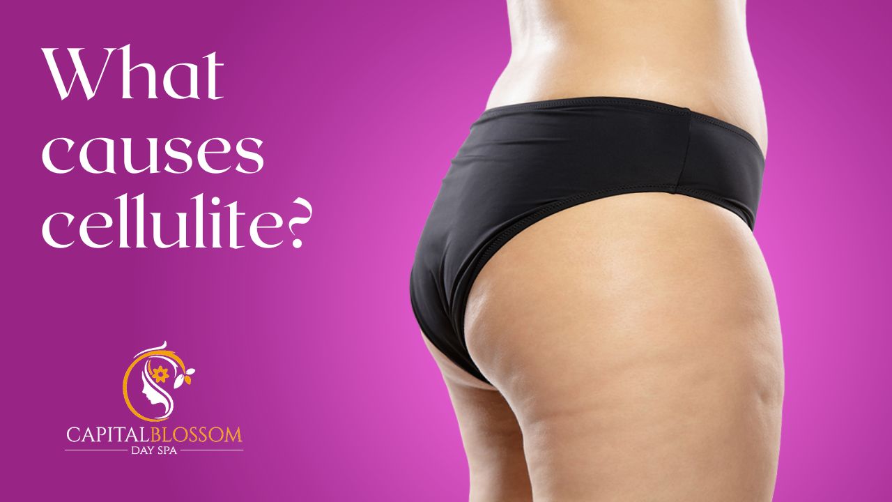 ⚡️Client Results - Cellulite Reduction! ⁠ ⁠ Cellulite can occur due to  various factors, irrespective of your lifestyle, such as a