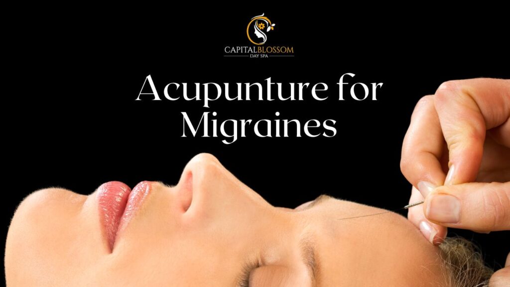 acupuncture for migraines