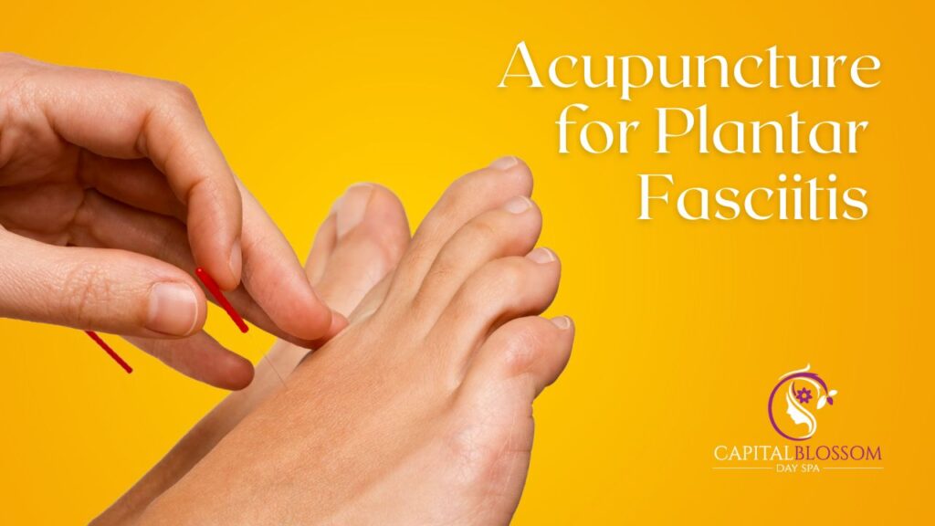 acupuncture for plantar fasciitis