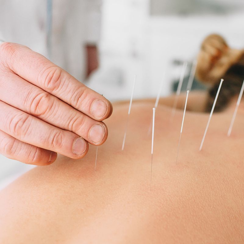 acupuncture for back pain (1)