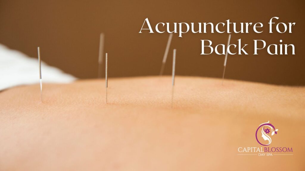 acupuncture for back pain