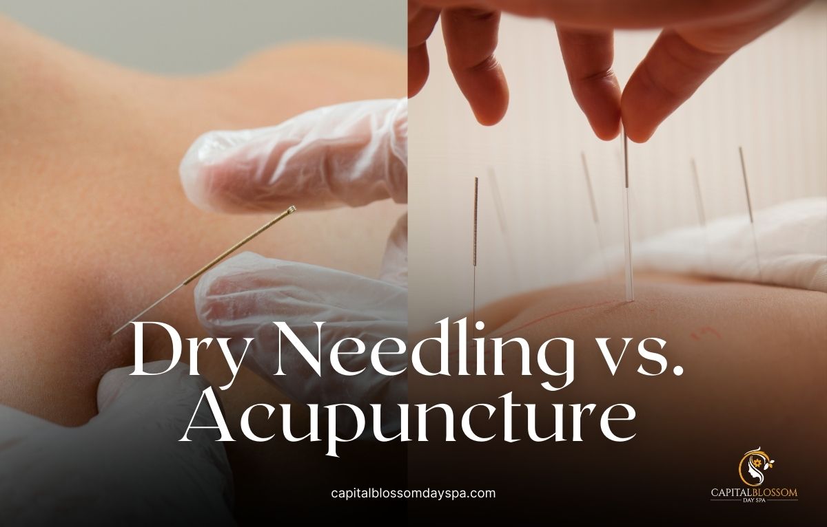 Read more about the article Dry Needling vs Acupuncture – What’s the Difference?