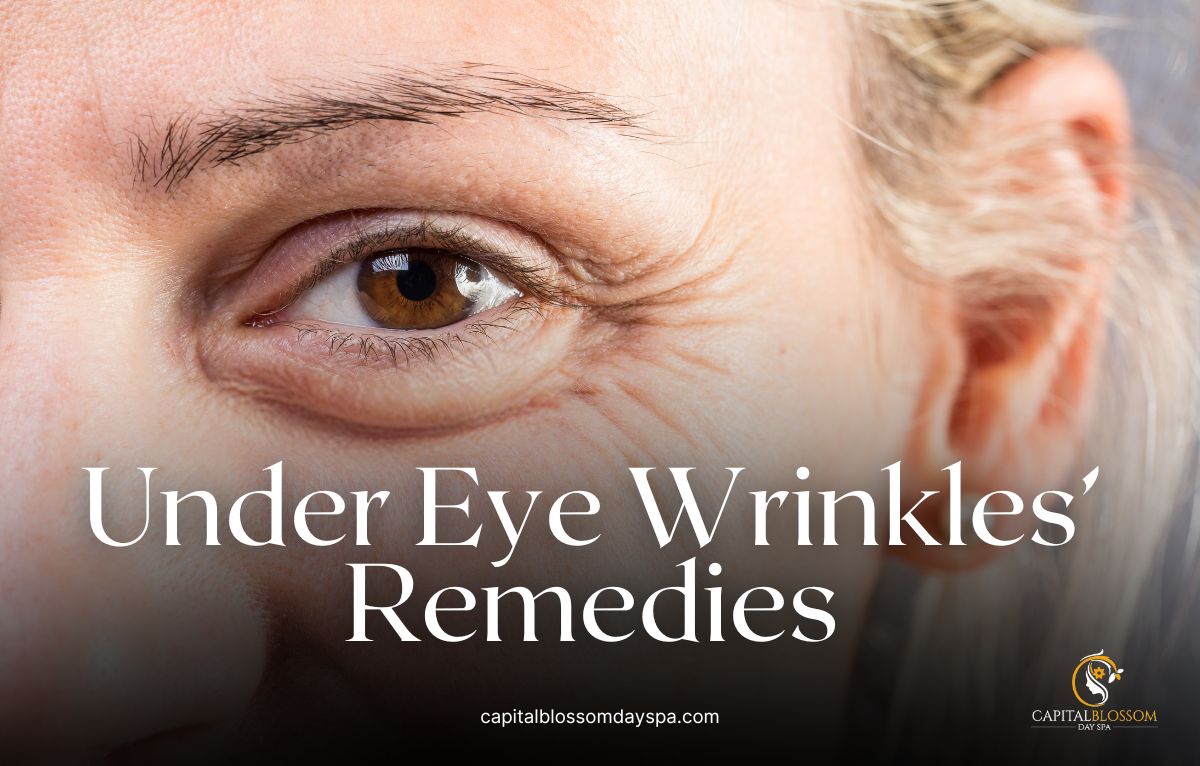 Read more about the article 10 Proven Remedies for Under Eye Wrinkles That Actually Work