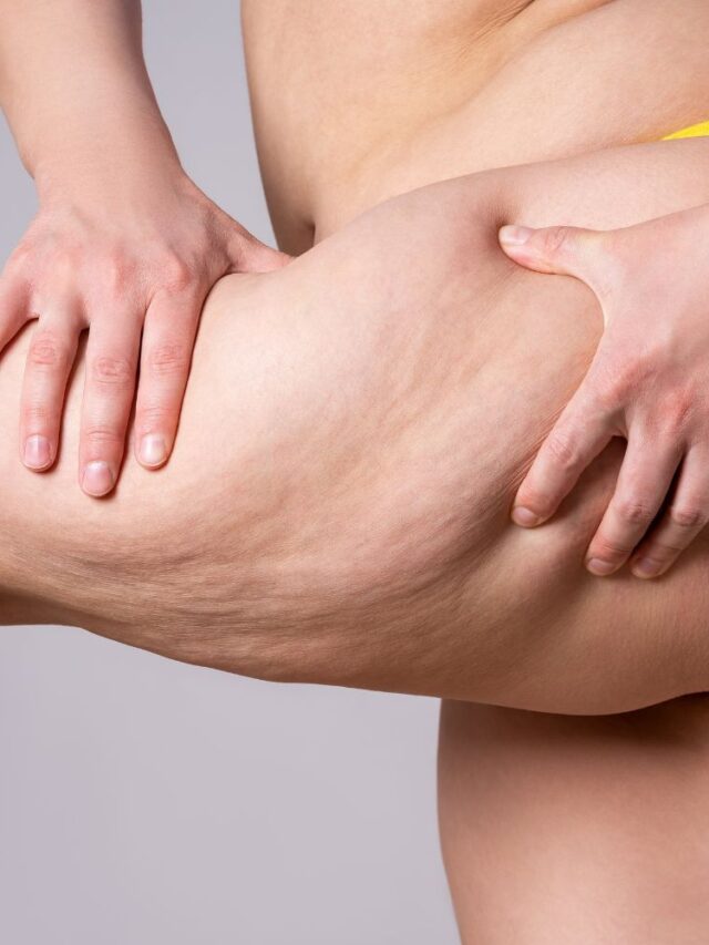 Read more about the article How to Get Rid of Cellulite on Thighs